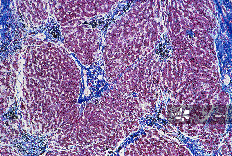 显示肝硬化的人肝脏光镜图图片素材