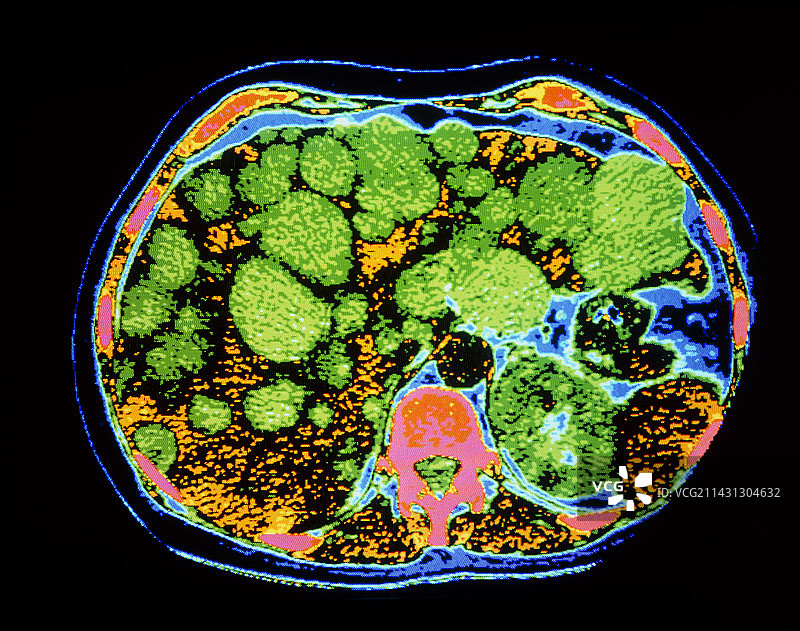 肝脏多囊病F/彩色CT扫描图片素材
