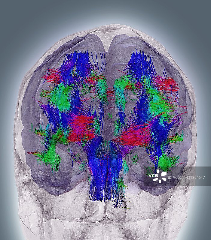 大脑白质3D核磁共振扫描图片素材