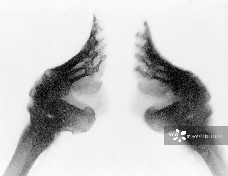 中国女孩的缠足X光片图片素材