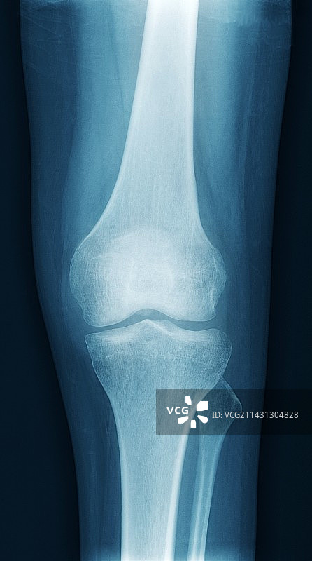 健康的膝盖X光片图片素材