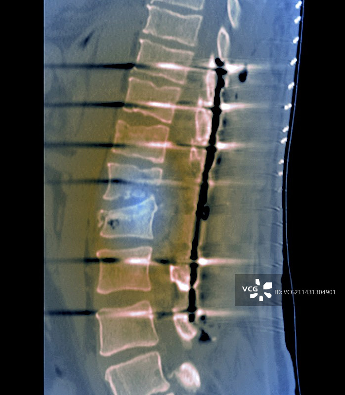 CT扫描显示断背的脊柱融合手术图片素材