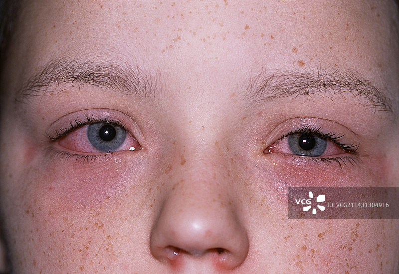 过敏性结膜炎图片素材