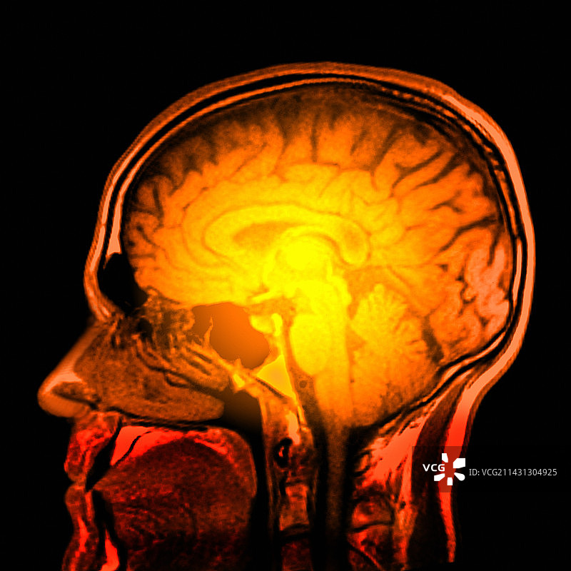 大脑解剖核磁共振扫描图片素材