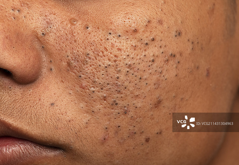 寻常痤疮图片素材