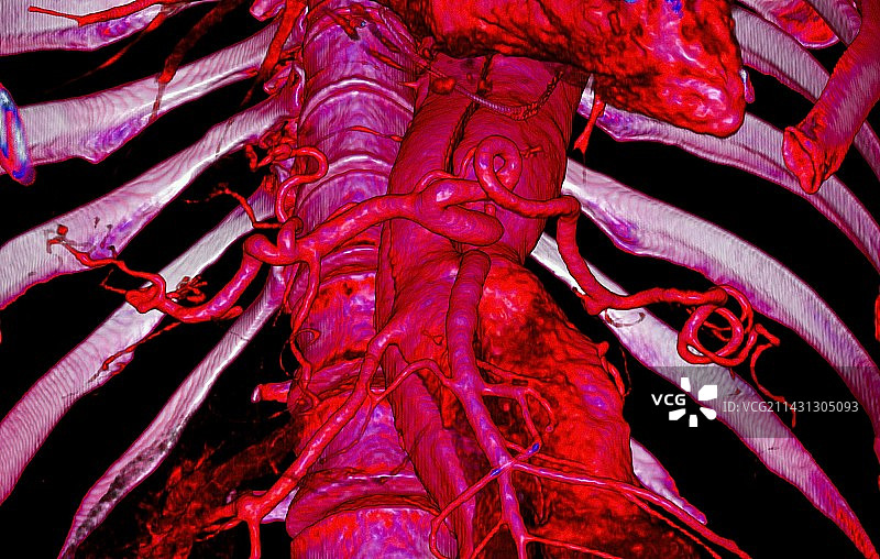 主动脉动脉瘤3D CT扫描图片素材