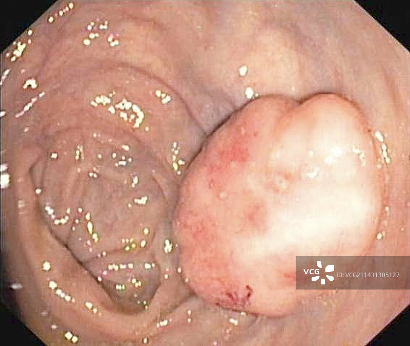 直肠癌图片素材