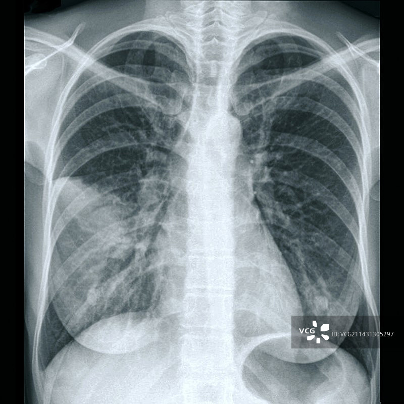 肺炎中的肺部X光片图片素材