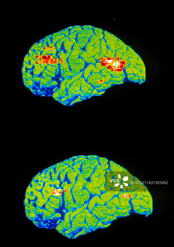 抑郁症和正常大脑的PET扫描图片素材