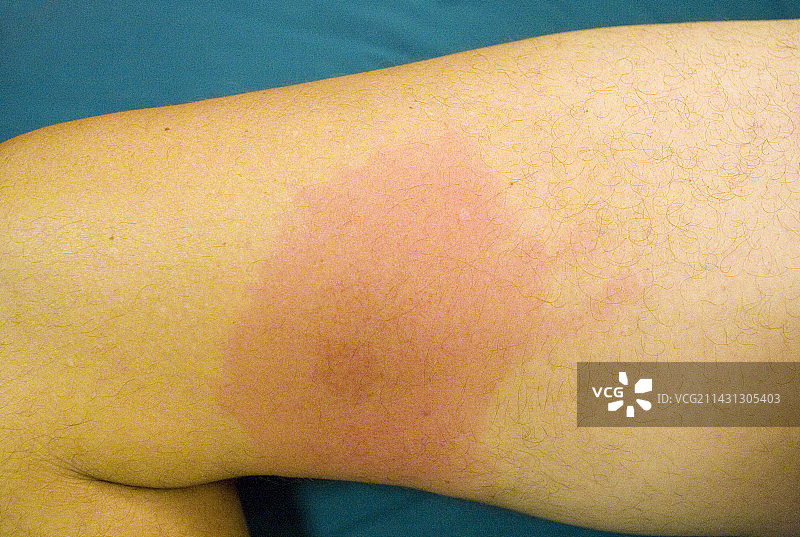 游走性红斑皮疹图片素材
