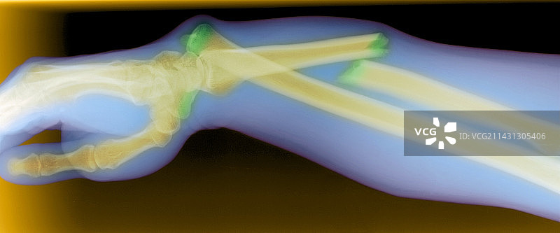 手臂骨折和手腕脱臼图片素材