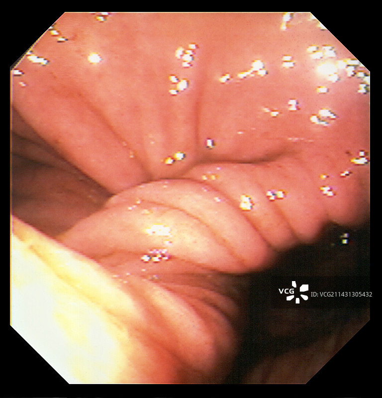 胃部不适图片素材