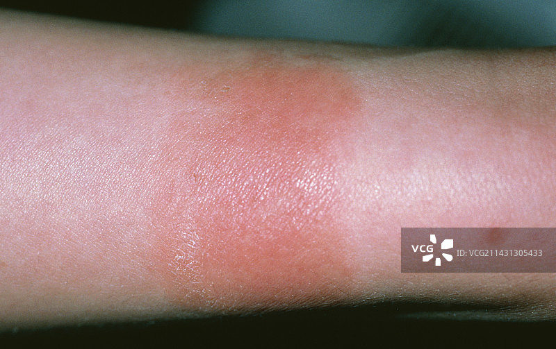 接触性皮炎：腕表过敏图片素材