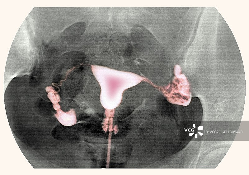 女性生殖器官X光片图片素材