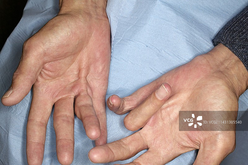 杜普伊特伦挛缩图片素材