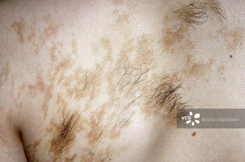 贝克尔痣图片素材