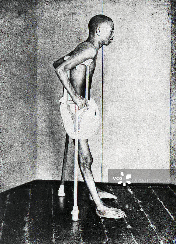 1914年的脚气病患者图片素材