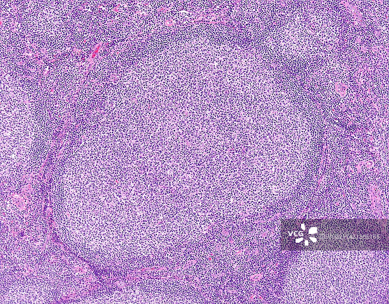 滤泡性淋巴瘤显微照片图片素材