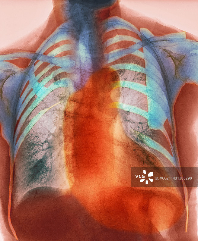 心脏扩大X光片图片素材