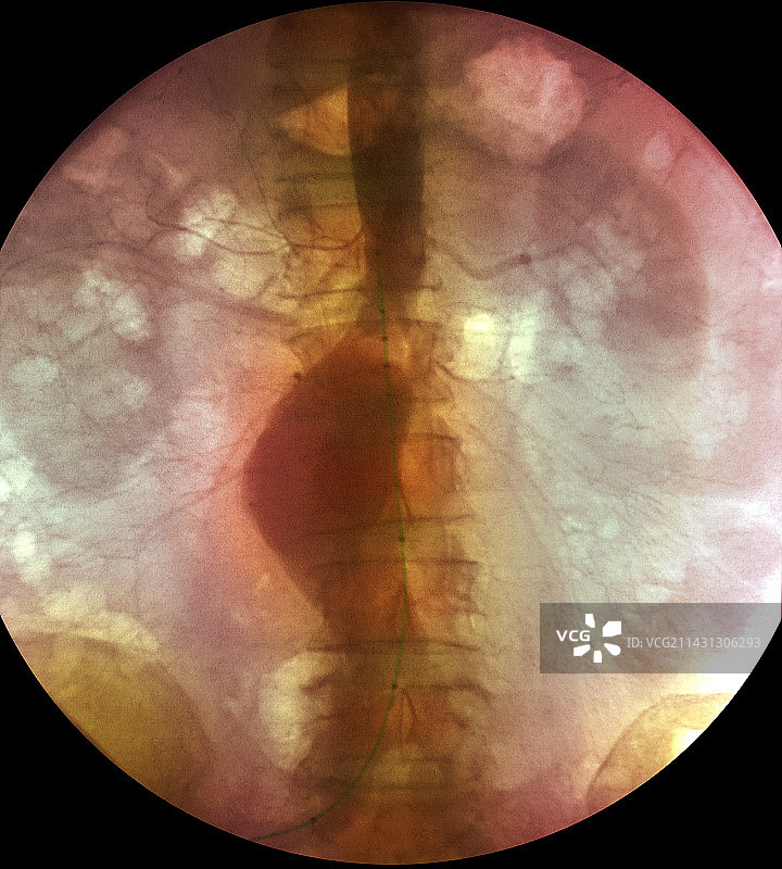 主动脉动脉瘤图片素材