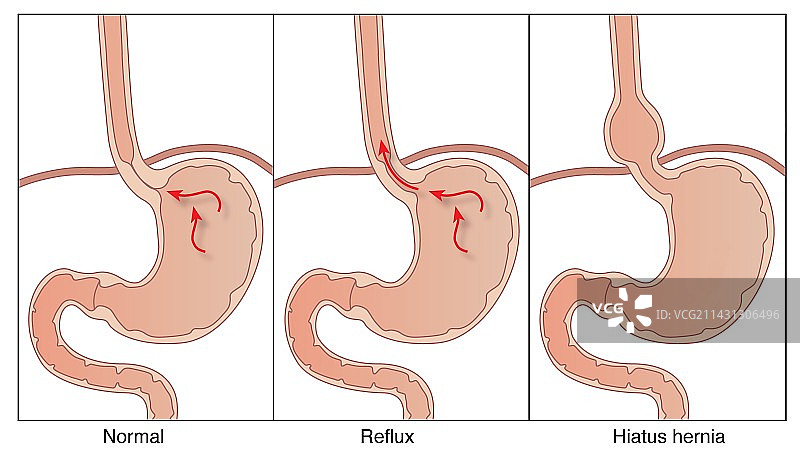 胃部疾病医学插图图片素材