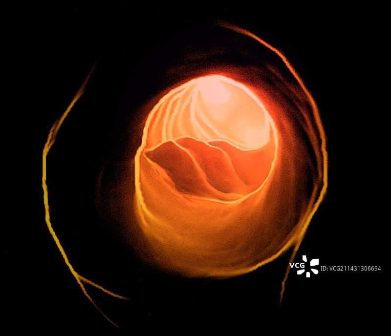 颈动脉粥样硬化，CT图片素材