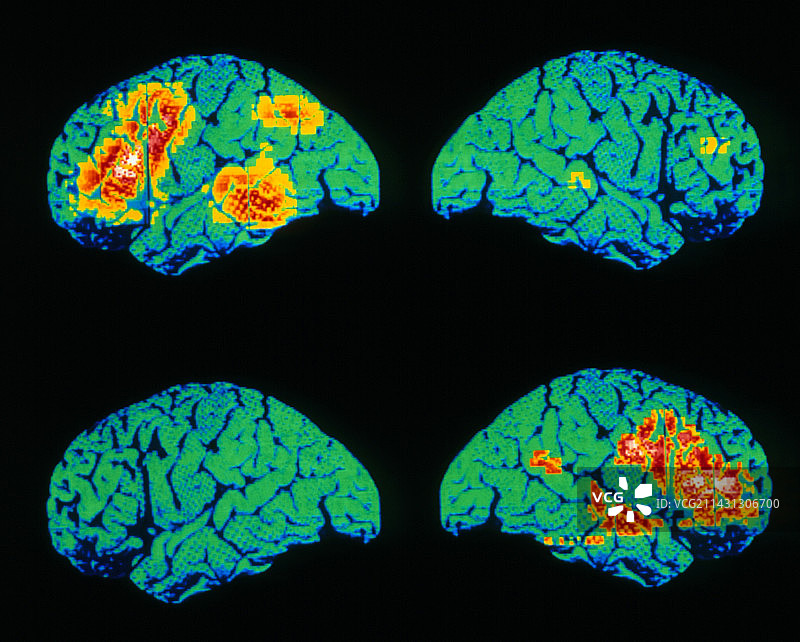 大脑语言区域的PET扫描彩色图图片素材