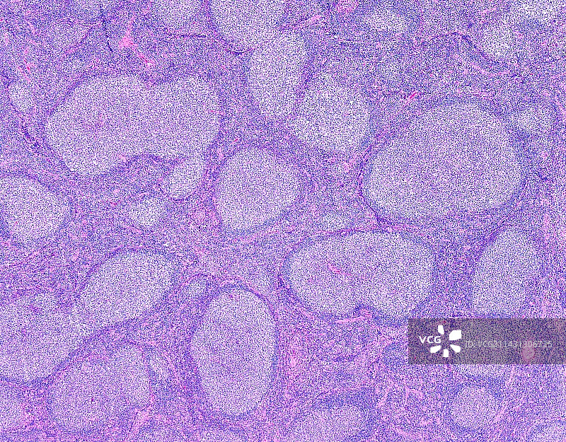 滤泡性淋巴瘤显微照片图片素材