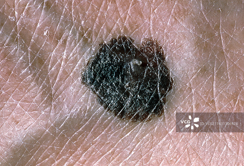 患者足部的恶性黑素瘤图片素材