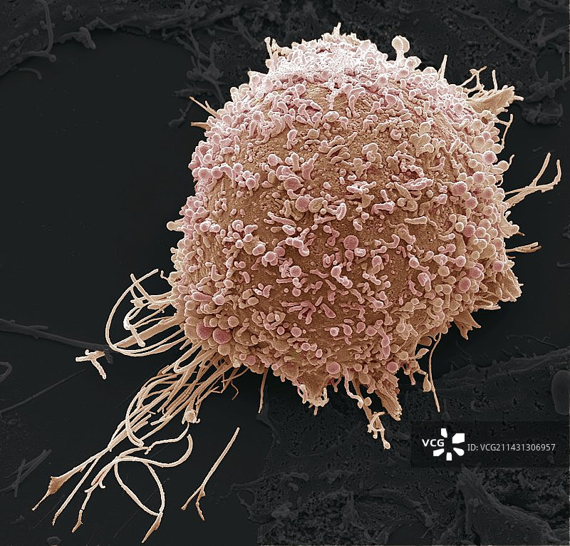 宫颈癌细胞扫描电镜图图片素材