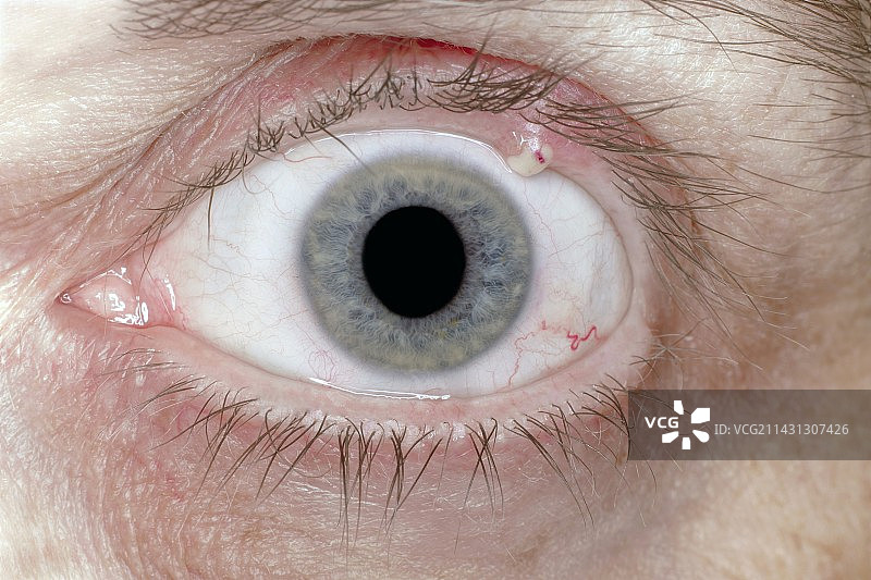 细菌性眼睑感染图片素材