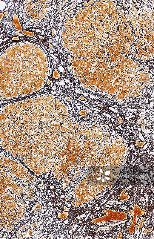 肝硬化显微照片图片素材