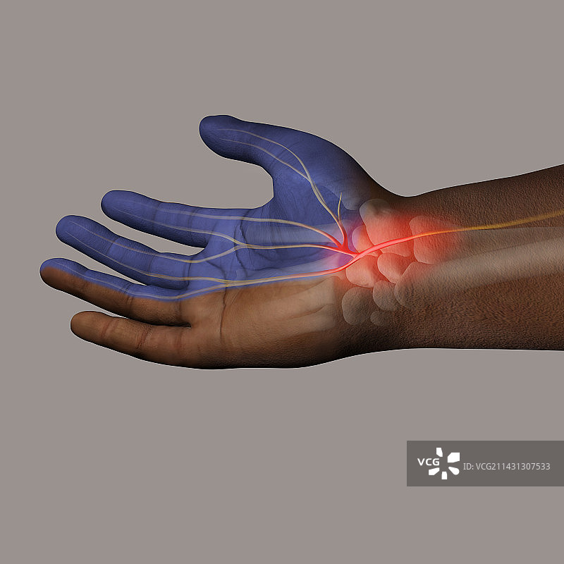 腕管综合征插图图片素材