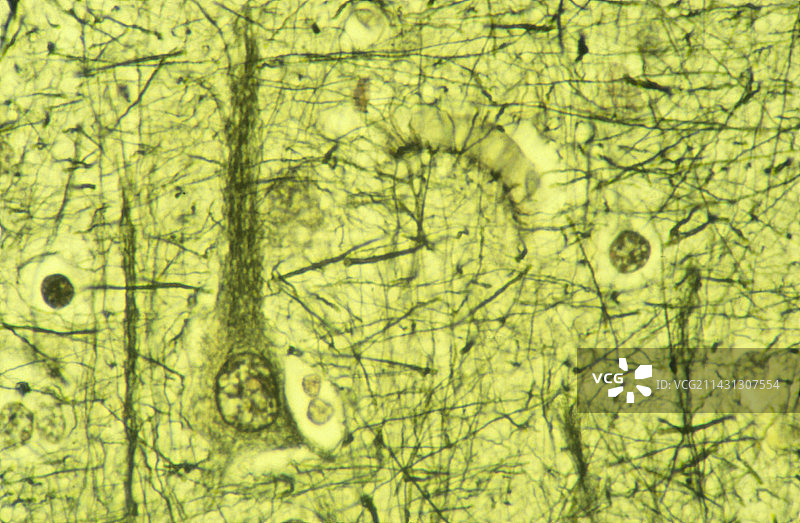 阿尔茨海默病脑组织图片素材