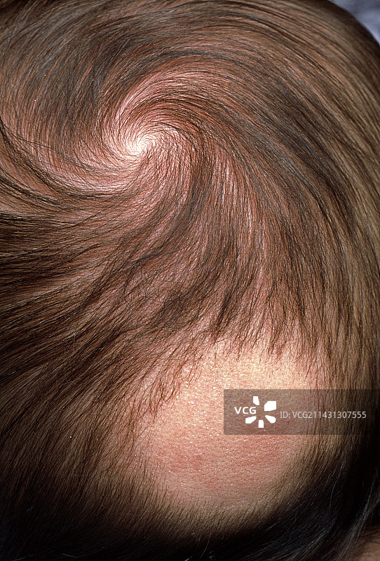 3个月大婴儿后脑勺上的秃斑图片素材