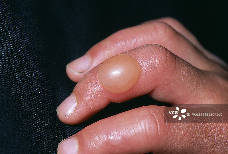 皮肤感染图片素材