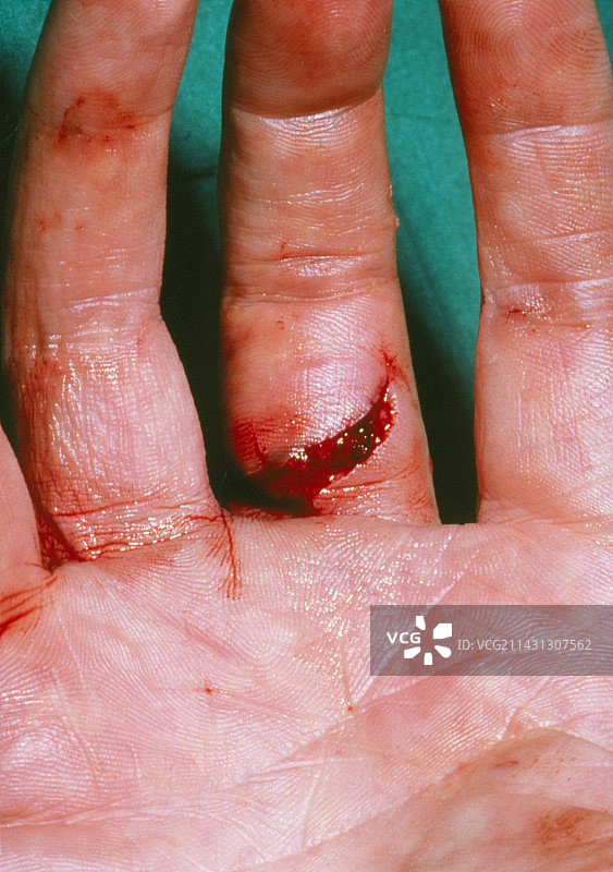 手部展示手指严重撕裂伤图片素材
