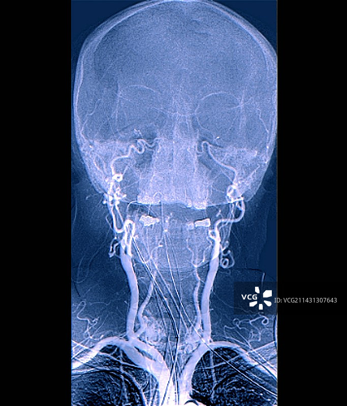 脑死亡测试血管造影图片素材