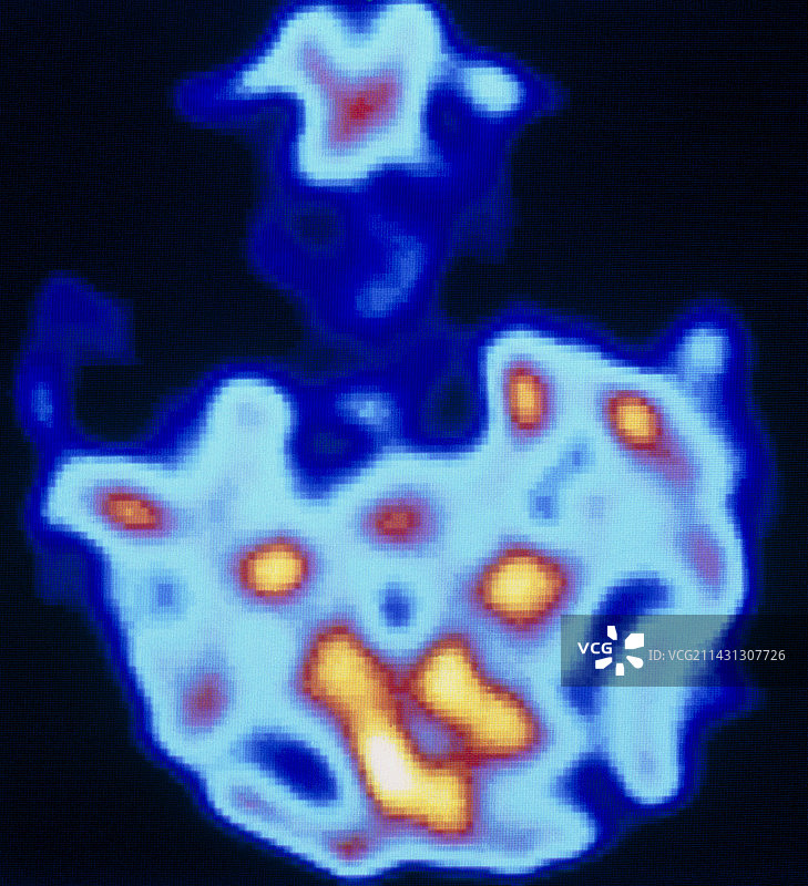 癫痫患者的大脑图片素材