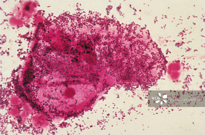 细菌性阴道病，宫颈涂片图片素材
