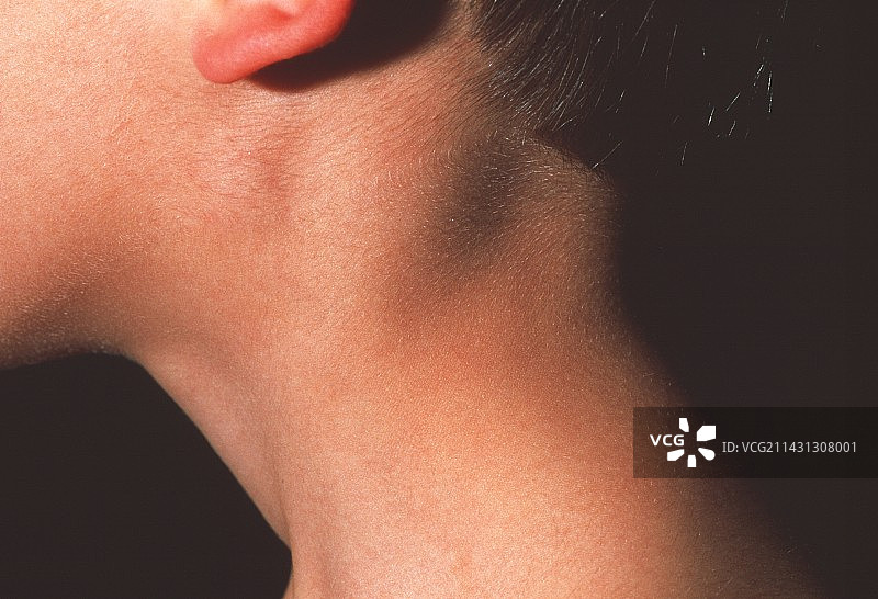 肿胀的颈部腺体图片素材