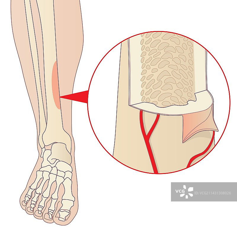 胫骨夹板图片素材