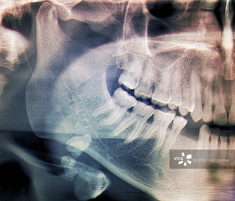 唾液腺结石X光片图片素材