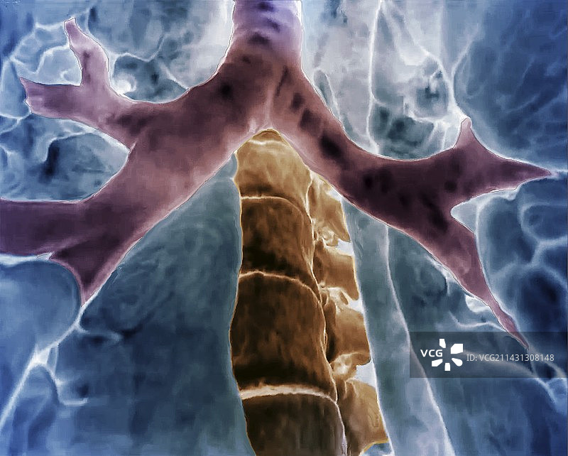 支气管分支3D CT扫描图片素材