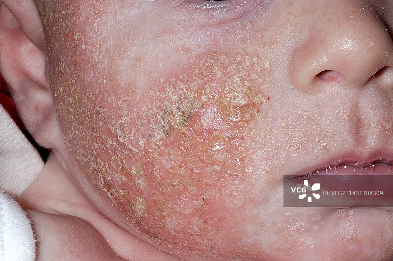 感染的湿疹图片素材