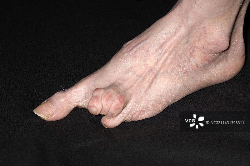 硬皮病图片素材