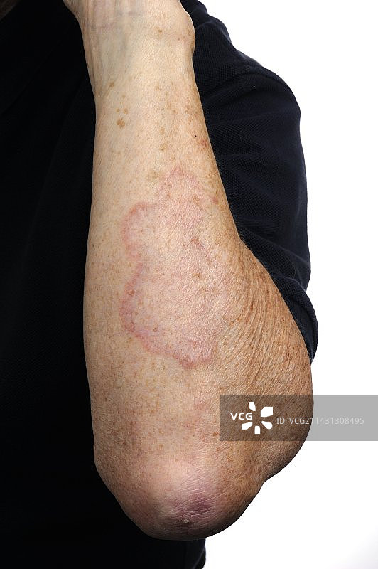 手臂上的环状肉芽肿图片素材