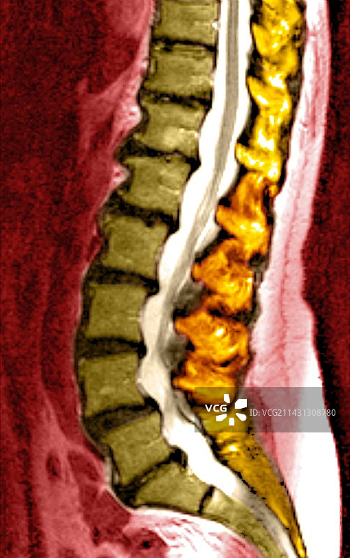 脊椎退化核磁共振扫描图片素材