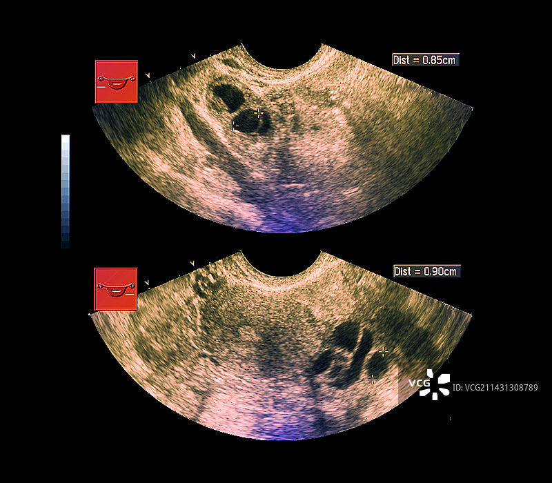 卵巢囊肿，超声波扫描图片素材