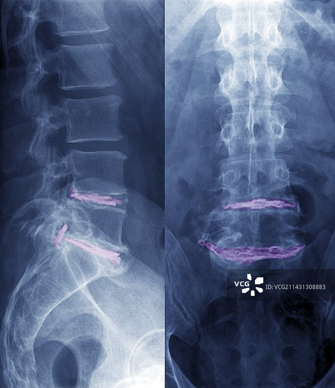 坐骨神经痛X光片图片素材